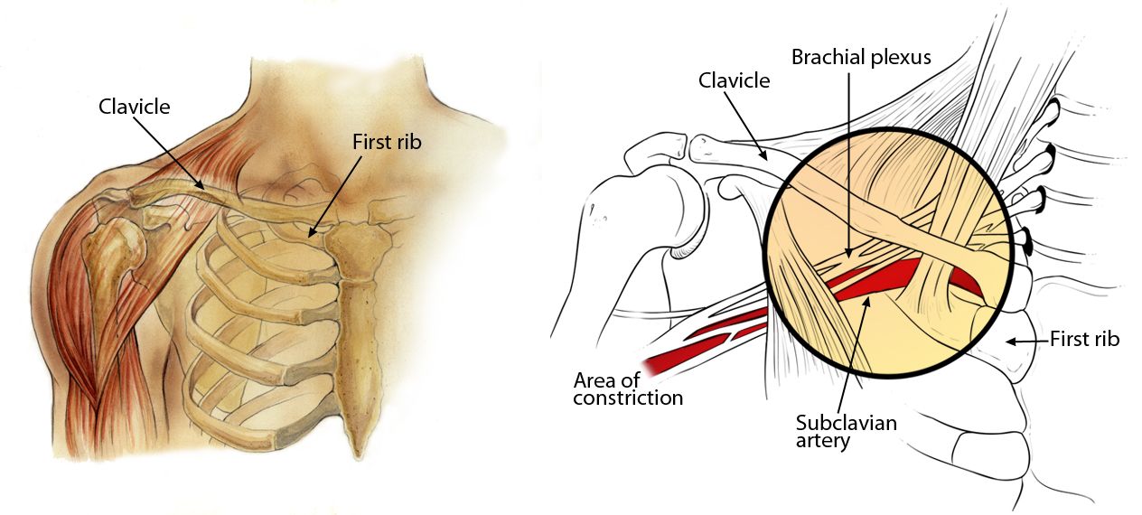 Understand and Manage Thoracic Outlet Syndrome Effectively